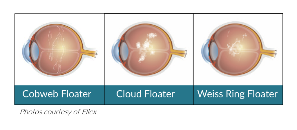 Floater Treatment NoVA Eye MD